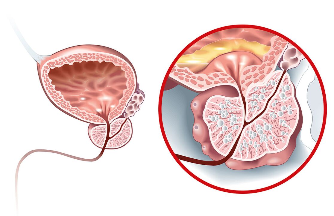 Co se stane s prostatou s adenomem a prostatitidou