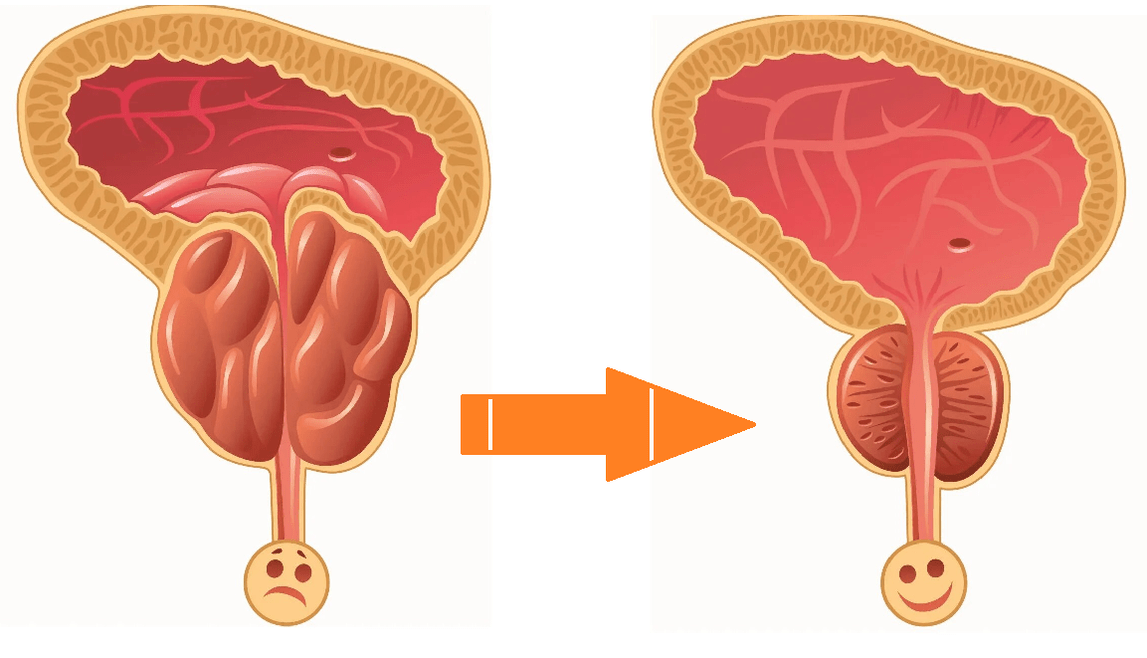 Účinek Uromexil Forte na prostatu s prostatitidou a adenomem